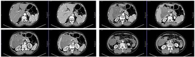 Retroperitoneal Spindle Cell Tumor: A Case Report